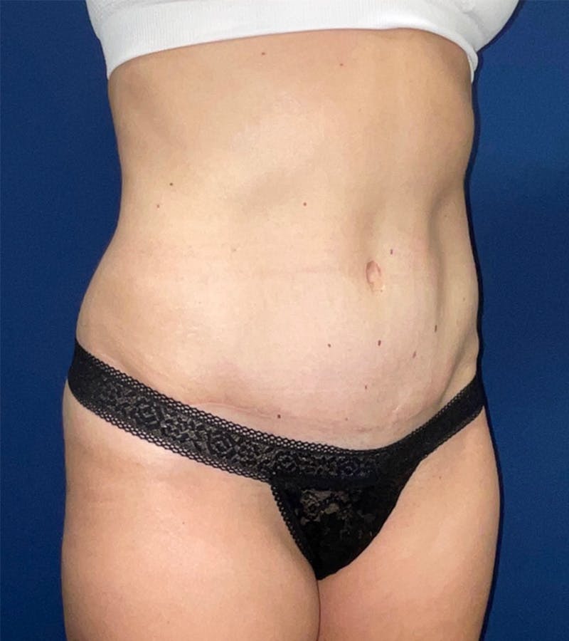 Tummy Tuck by Dr. Haydon Before & After Gallery - Patient 55709093 - Image 4