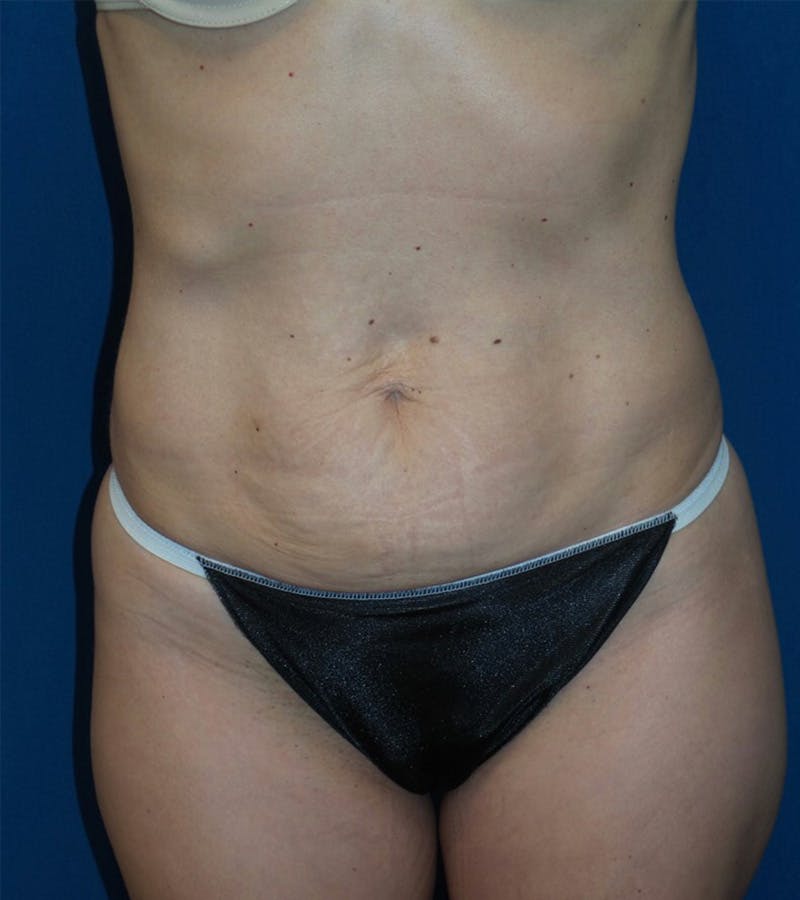 Tummy Tuck by Dr. Haydon Before & After Gallery - Patient 55709093 - Image 5