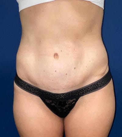 Tummy Tuck by Dr. Haydon Before & After Gallery - Patient 55709093 - Image 2