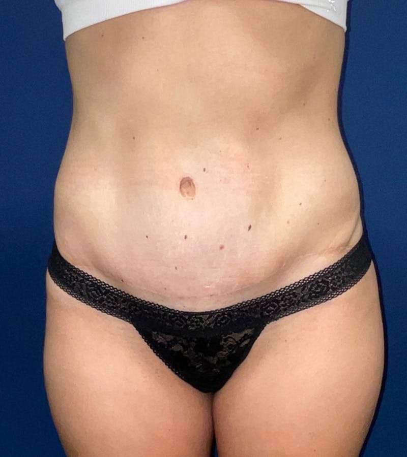Tummy Tuck by Dr. Haydon Before & After Gallery - Patient 55709093 - Image 6