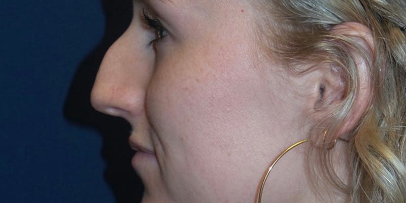 Rhinoplasty by Dr. Haydon Before & After Gallery - Patient 55709101 - Image 1
