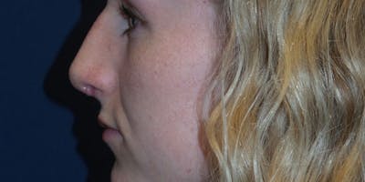 Rhinoplasty by Dr. Haydon Before & After Gallery - Patient 55709101 - Image 2