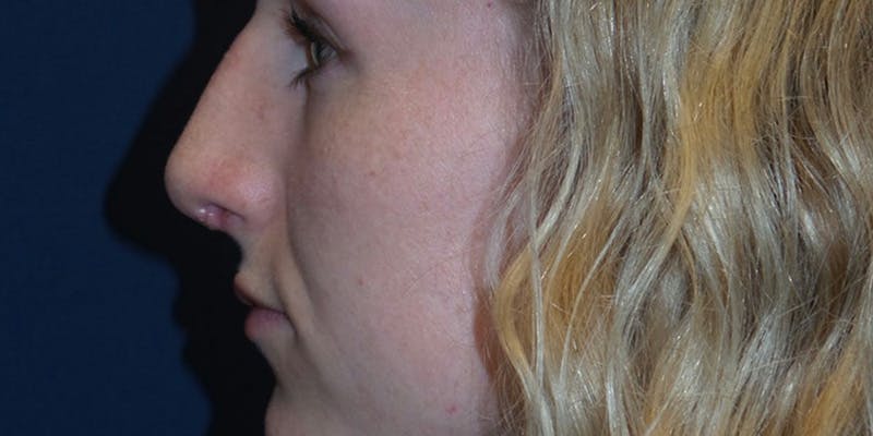 Rhinoplasty by Dr. Haydon Before & After Gallery - Patient 55709101 - Image 2