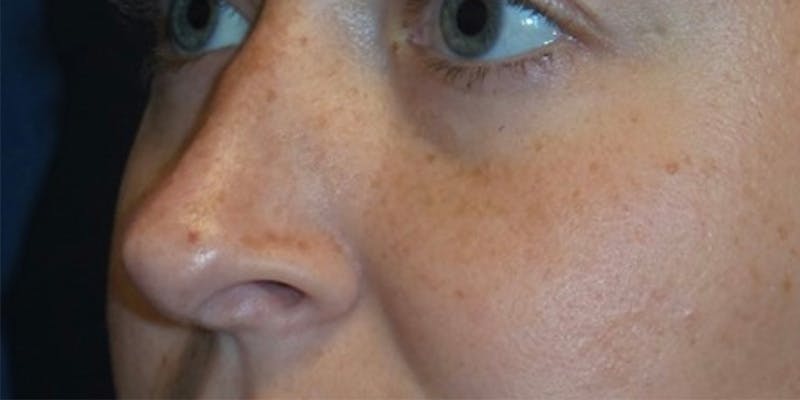 Rhinoplasty by Dr. Haydon Before & After Gallery - Patient 55709102 - Image 2
