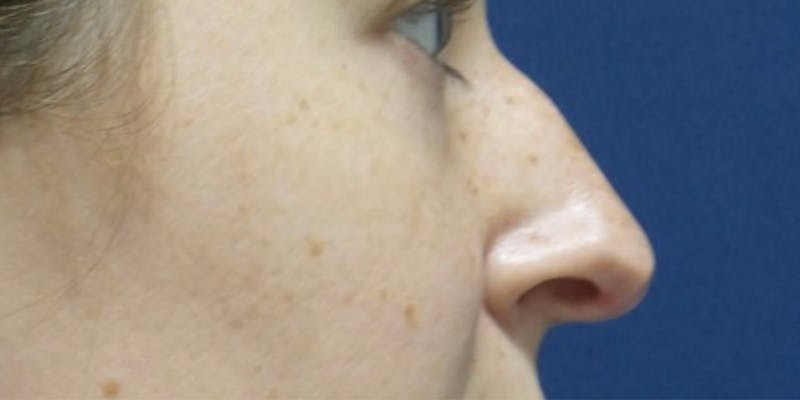 Rhinoplasty by Dr. Haydon Before & After Gallery - Patient 55709104 - Image 1