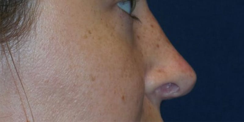 Rhinoplasty by Dr. Haydon Before & After Gallery - Patient 55709104 - Image 2