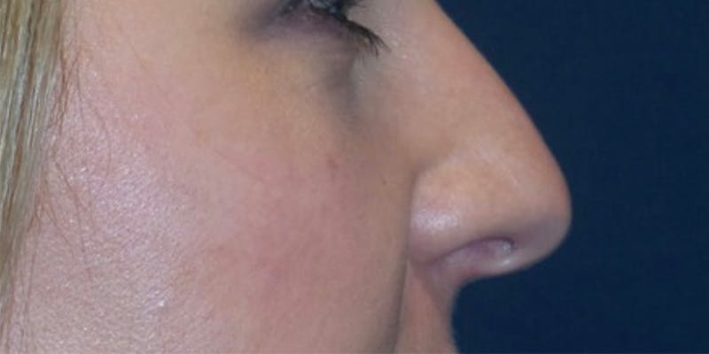 Rhinoplasty by Dr. Haydon Before & After Gallery - Patient 55709103 - Image 1