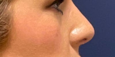 Rhinoplasty by Dr. Haydon Before & After Gallery - Patient 55709103 - Image 2