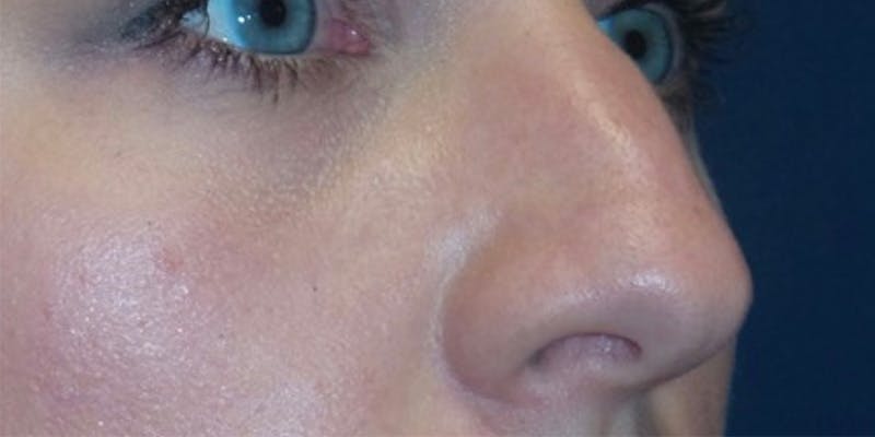 Rhinoplasty by Dr. Haydon Before & After Gallery - Patient 55709103 - Image 3