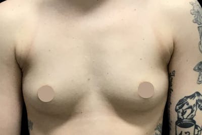 Breast Augmentation by Dr. Booth Before & After Gallery - Patient 64104424 - Image 1