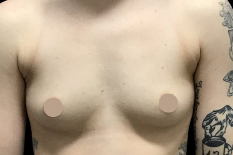 Breast Augmentation by Dr. Booth Before & After Gallery - Patient 64104424 - Image 1