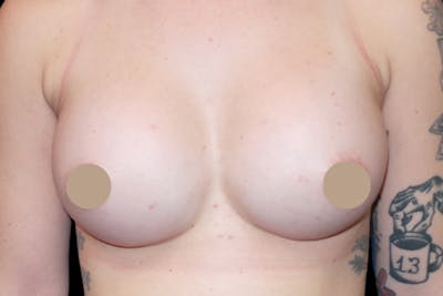 Breast Augmentation by Dr. Booth Before & After Gallery - Patient 64104424 - Image 2