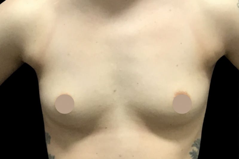 Breast Augmentation by Dr. Booth Before & After Gallery - Patient 64104424 - Image 3