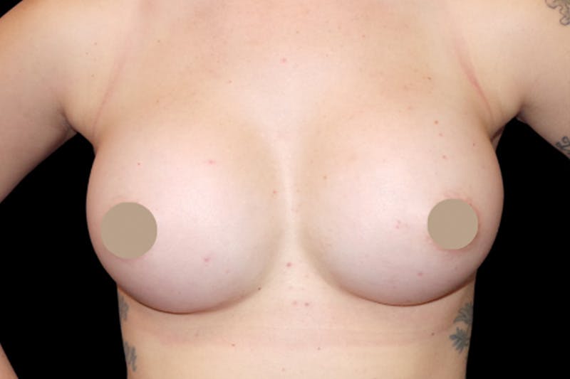 Breast Augmentation by Dr. Booth Before & After Gallery - Patient 64104424 - Image 4