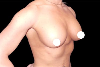 Breast Revision by Dr. Booth Before & After Gallery - Patient 64104428 - Image 1