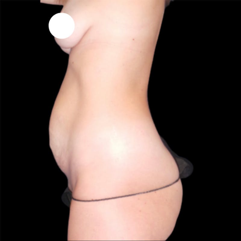Tummy Tuck by Dr. Booth Before & After Gallery - Patient 64104435 - Image 1