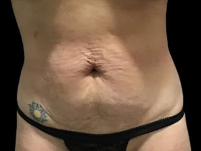 Tummy Tuck by Dr. Booth Before & After Gallery - Patient 64104434 - Image 1