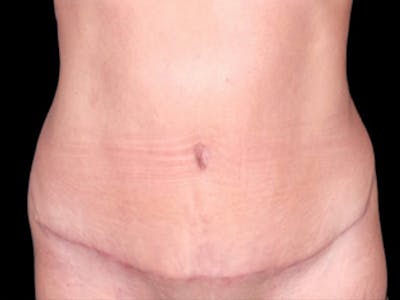 Tummy Tuck by Dr. Booth Before & After Gallery - Patient 64104434 - Image 2