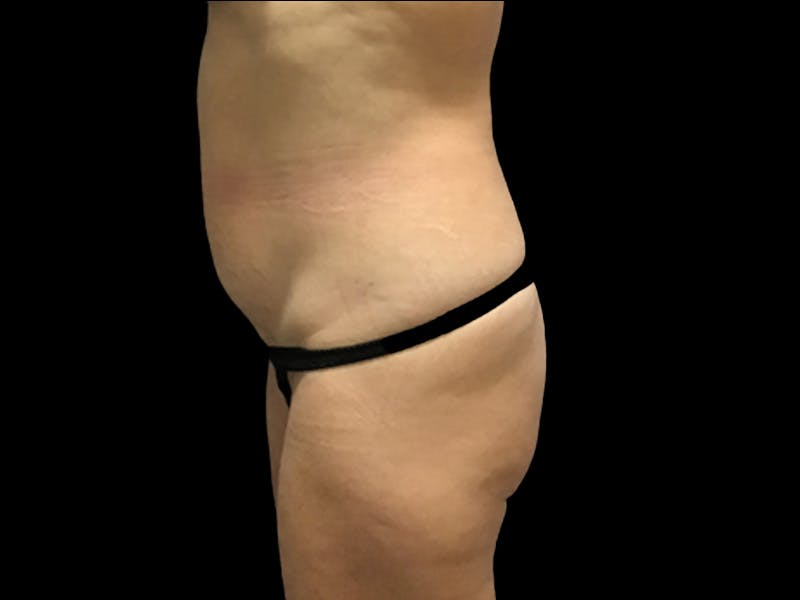 Tummy Tuck by Dr. Booth Before & After Gallery - Patient 64104434 - Image 3
