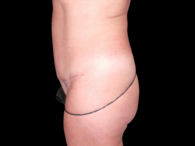 Tummy Tuck by Dr. Booth Before & After Gallery - Patient 64104434 - Image 4