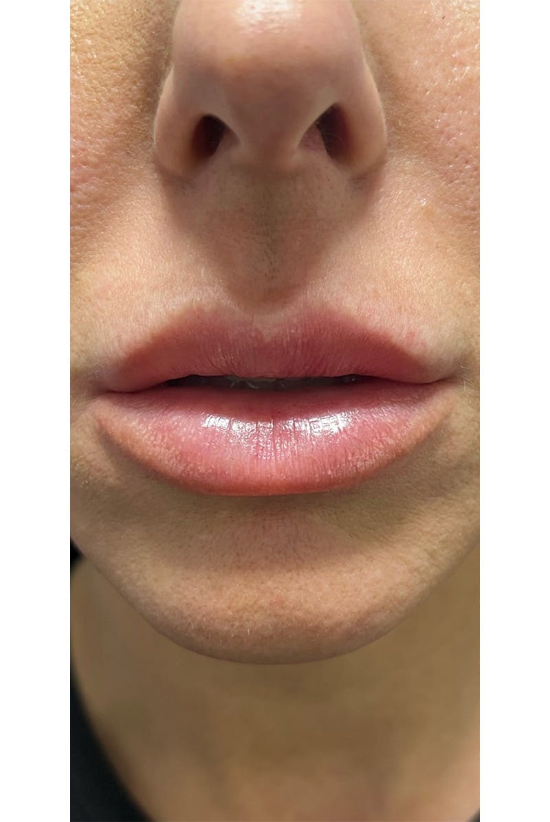 Bullhorn Lip Lift by Dr. Booth Before & After Gallery - Patient 76352263 - Image 3