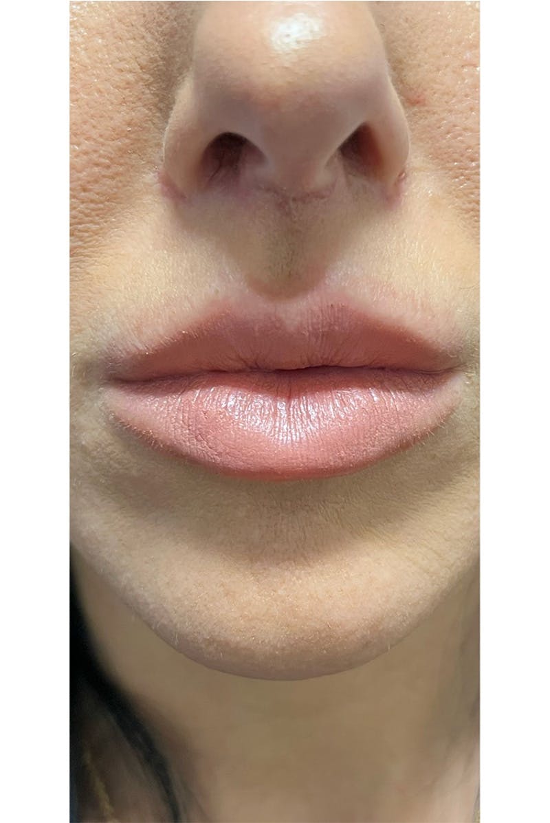 Bullhorn Lip Lift by Dr. Booth Before & After Gallery - Patient 76352263 - Image 4