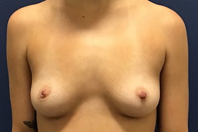 Breast Augmentation by Dr. Booth Before & After Gallery - Patient 87350455 - Image 1