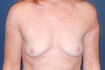 Breast Augmentation by Dr. Booth Before & After Gallery - Patient 87350454 - Image 1