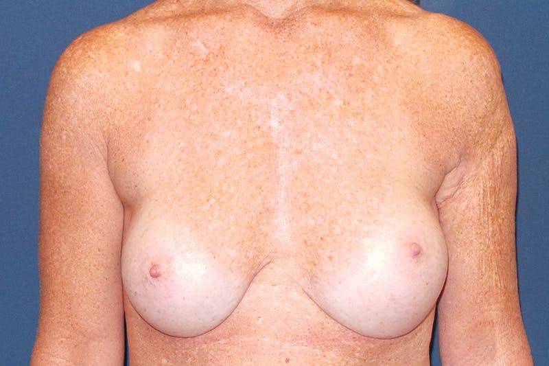 Breast Augmentation by Dr. Booth Before & After Gallery - Patient 87350454 - Image 2