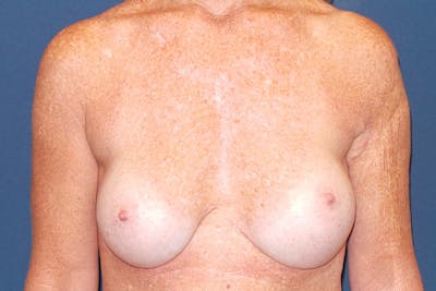 Breast Augmentation by Dr. Booth Before & After Gallery - Patient 87350454 - Image 2
