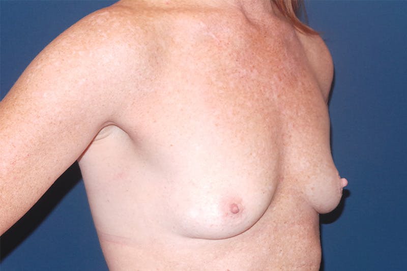 Breast Augmentation by Dr. Booth Before & After Gallery - Patient 87350454 - Image 3