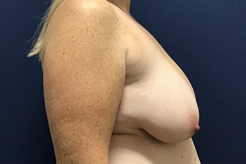 Breast Reduction by Dr. Booth Before & After Gallery - Patient 87720130 - Image 3