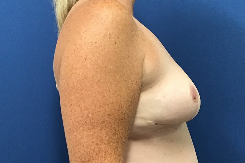 Breast Reduction by Dr. Booth Before & After Gallery - Patient 87720130 - Image 4