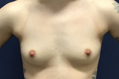 Breast Augmentation by Dr. Booth Before & After Gallery - Patient 90115893 - Image 1