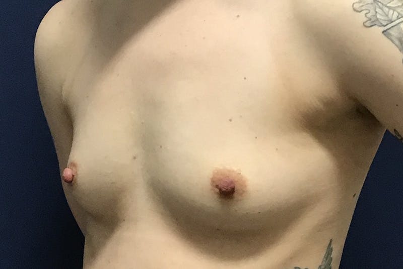 Breast Augmentation by Dr. Booth Before & After Gallery - Patient 90115893 - Image 3