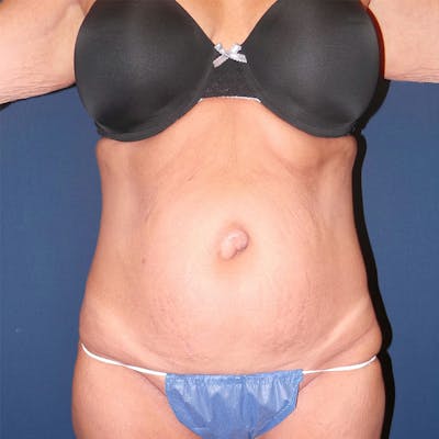 Tummy Tuck by Dr. Booth Before & After Gallery - Patient 90112764 - Image 1