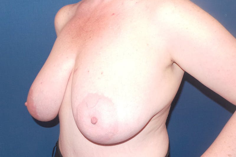 Breast Reduction by Dr. Booth Before & After Gallery - Patient 90115894 - Image 3