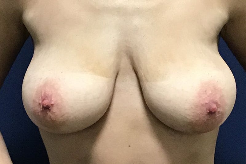 Breast Reduction by Dr. Booth Before & After Gallery - Patient 90115895 - Image 1