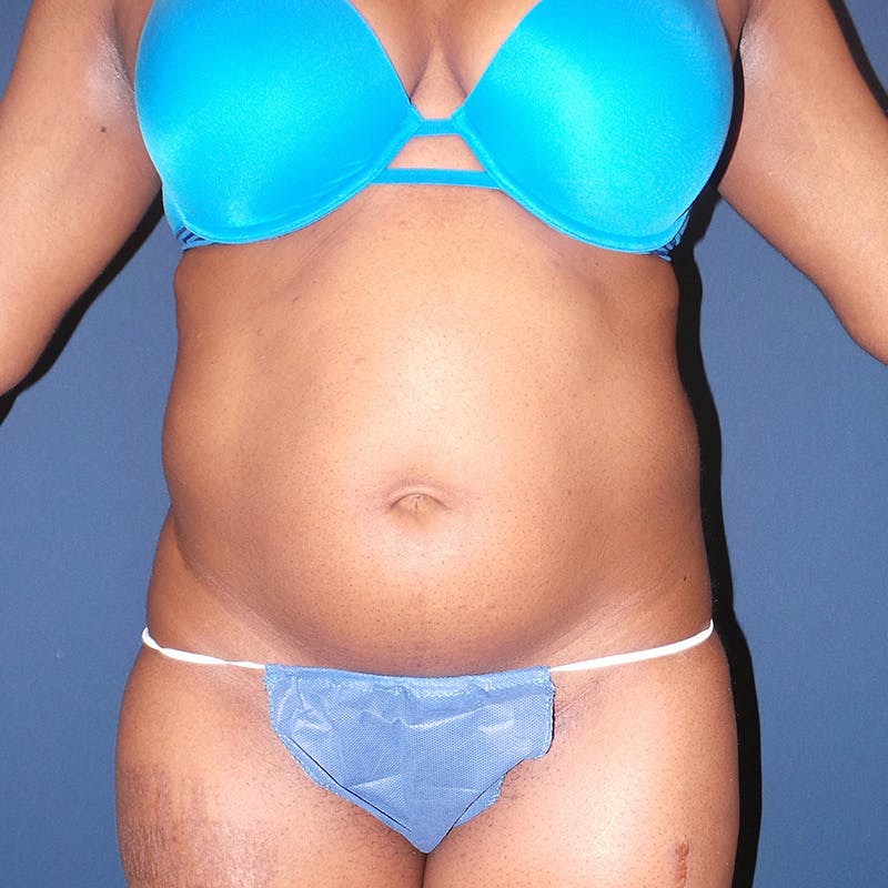 Lipo 360 by Dr. Booth Before & After Gallery - Patient 90115888 - Image 1