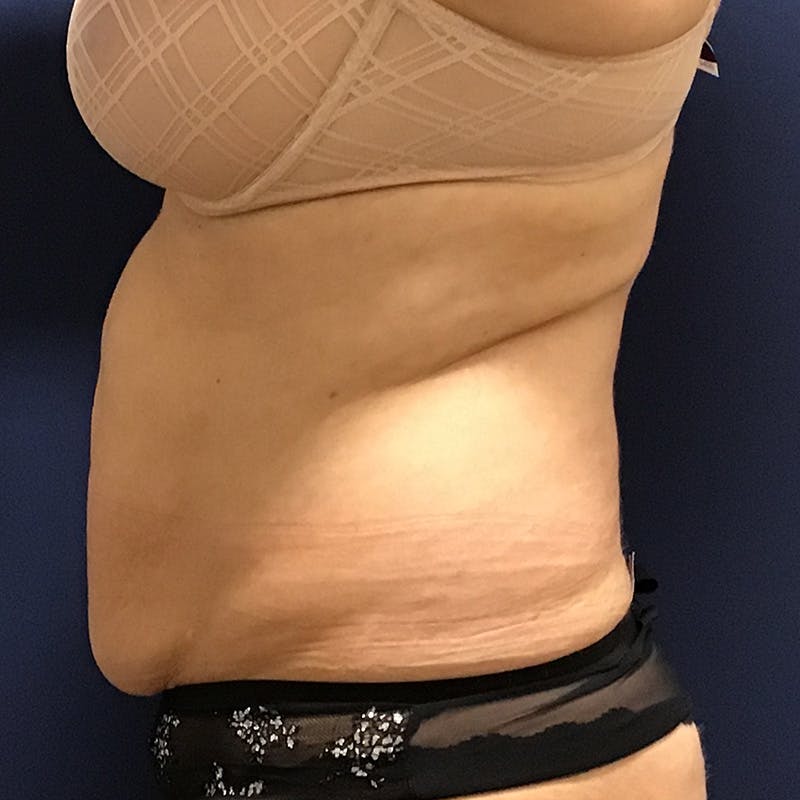 Tummy Tuck by Dr. Booth Before & After Gallery - Patient 90112745 - Image 3