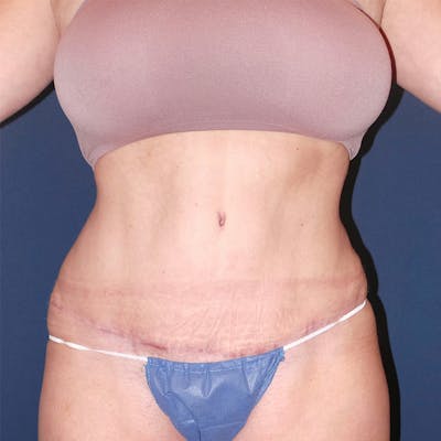 Tummy Tuck by Dr. Booth Before & After Gallery - Patient 90112745 - Image 2