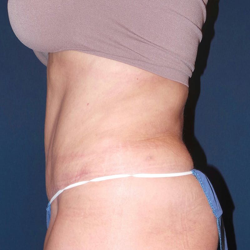 Tummy Tuck by Dr. Booth Before & After Gallery - Patient 90112745 - Image 4