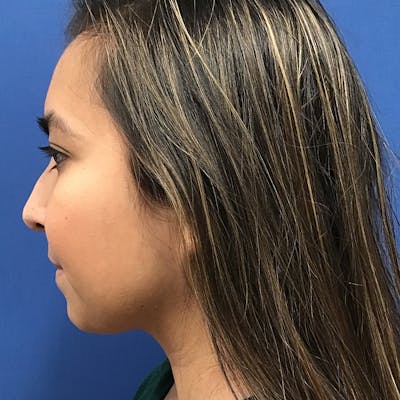 Chin Augmentation by Dr. Booth Before & After Gallery - Patient 90116072 - Image 1