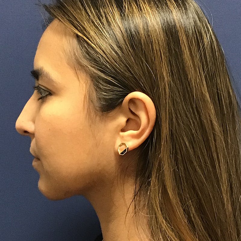 Chin Augmentation by Dr. Booth Before & After Gallery - Patient 90116072 - Image 2