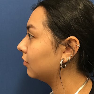 Chin Augmentation by Dr. Booth Before & After Gallery - Patient 90116071 - Image 1