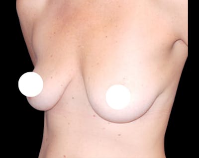 Breast Augmentation by Dr. Booth Before & After Gallery - Patient 64104430 - Image 1