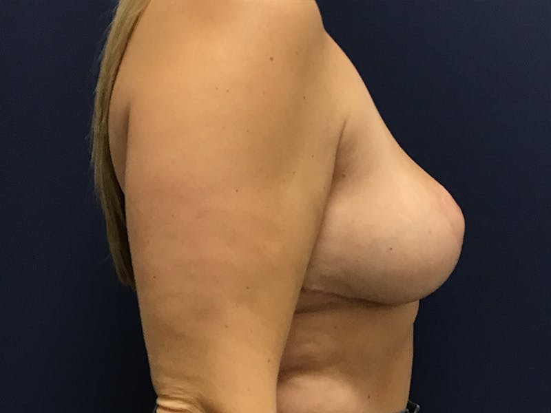 Breast Reduction by Dr. Booth Before & After Gallery - Patient 102709318 - Image 4
