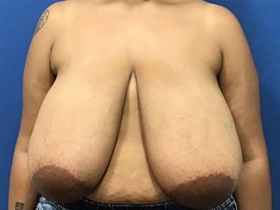 Breast Reduction by Dr. Booth Before & After Gallery - Patient 102709317 - Image 1