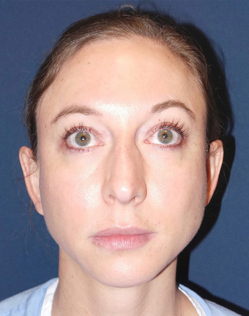 Rhinoplasty by Dr. Booth Before & After Gallery - Patient 102709360 - Image 3
