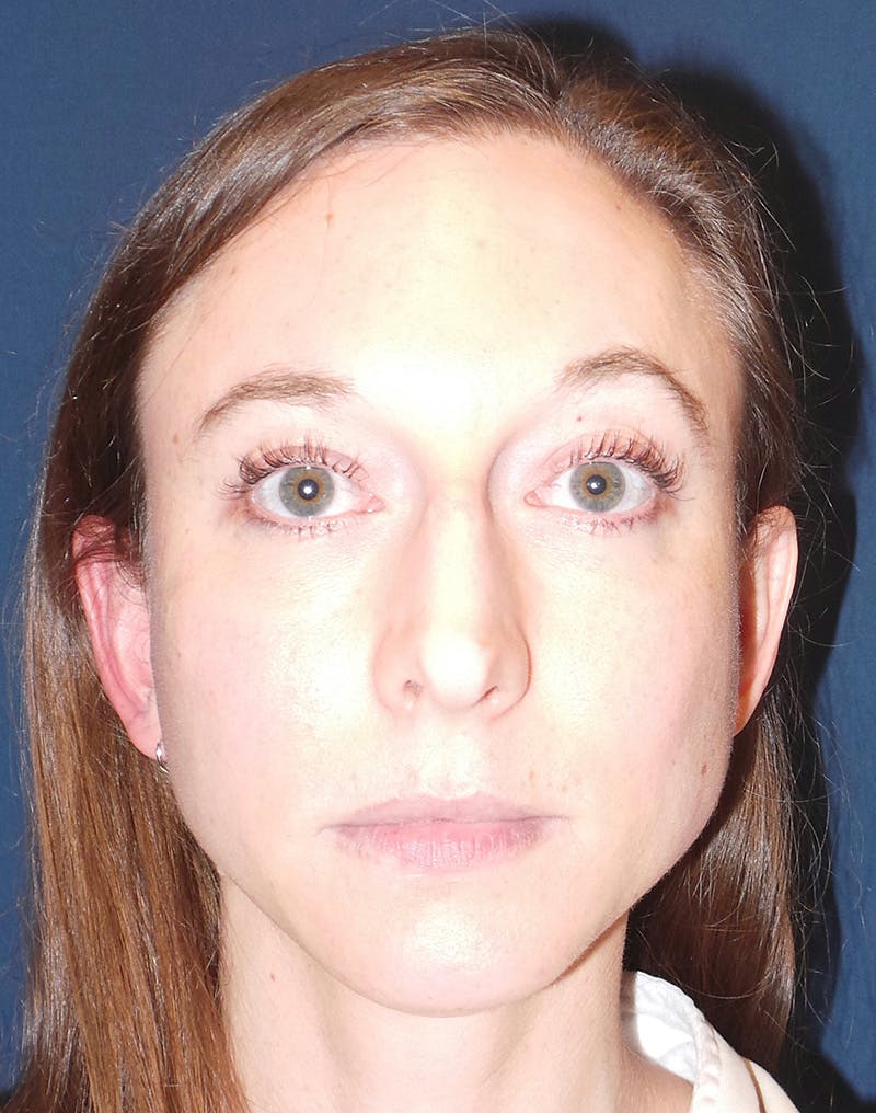 Rhinoplasty by Dr. Booth Before & After Gallery - Patient 102709360 - Image 4